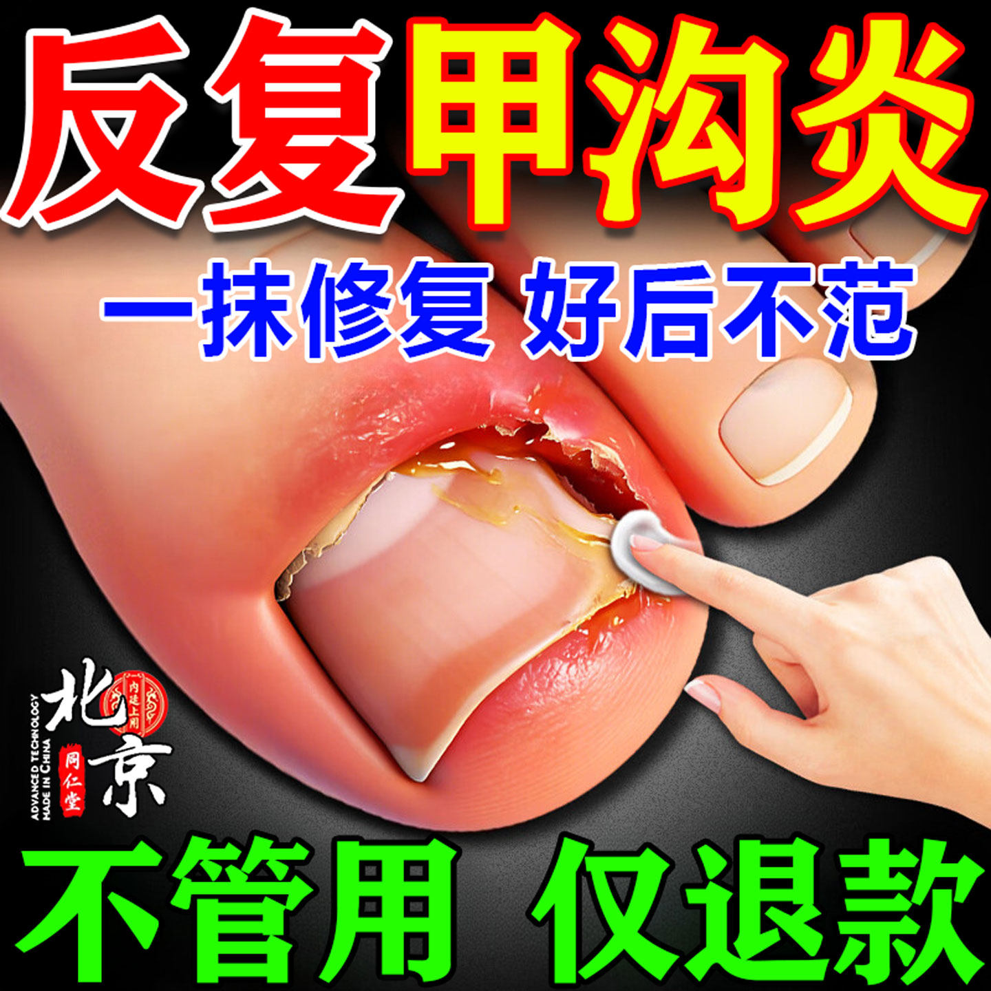 医用聚乙二醇护创敷料甲沟炎治疗专用效特膏药嵌甲息肉去除软化剂,医疗器械,保健理疗,淘宝优惠券,粉丝福利购,淘宝优惠卷