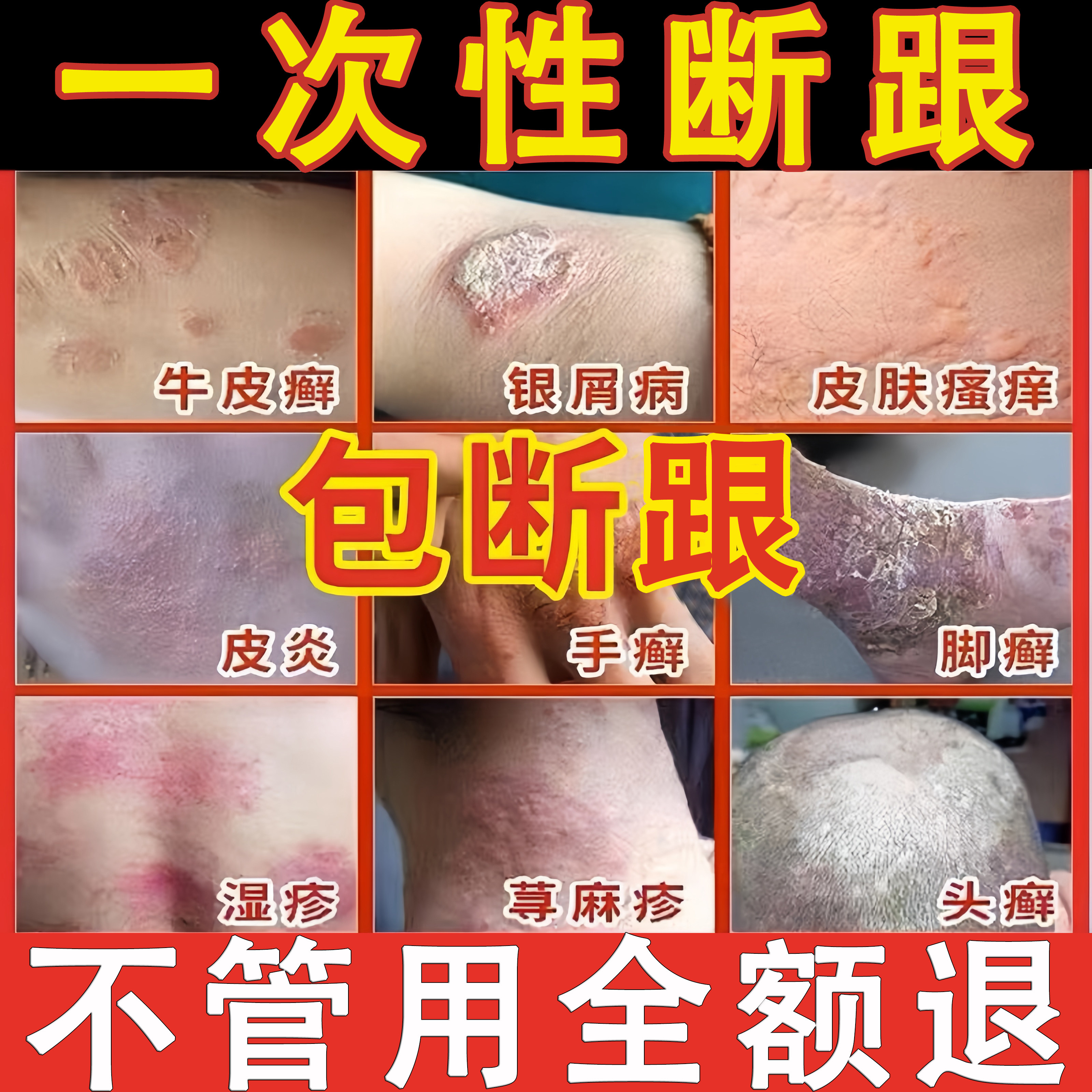疗治疹湿止痒根去荨疹麻外用顽固保健理疗
