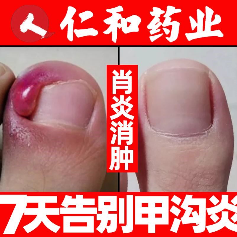 甲沟炎治疗专用药软甲消肿去肉芽消炎软膏息肉去除液膏正品旗舰店