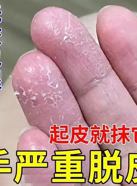 手足脱皮膏手上起皮干燥蜕皮疗专用治严重手指手掌脚底干裂褪皮掉