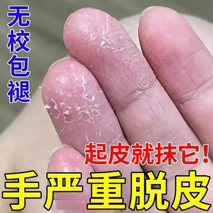 手足脱皮膏手上起皮干燥蜕皮疗专用治严重手指手掌脚底干裂褪皮掉