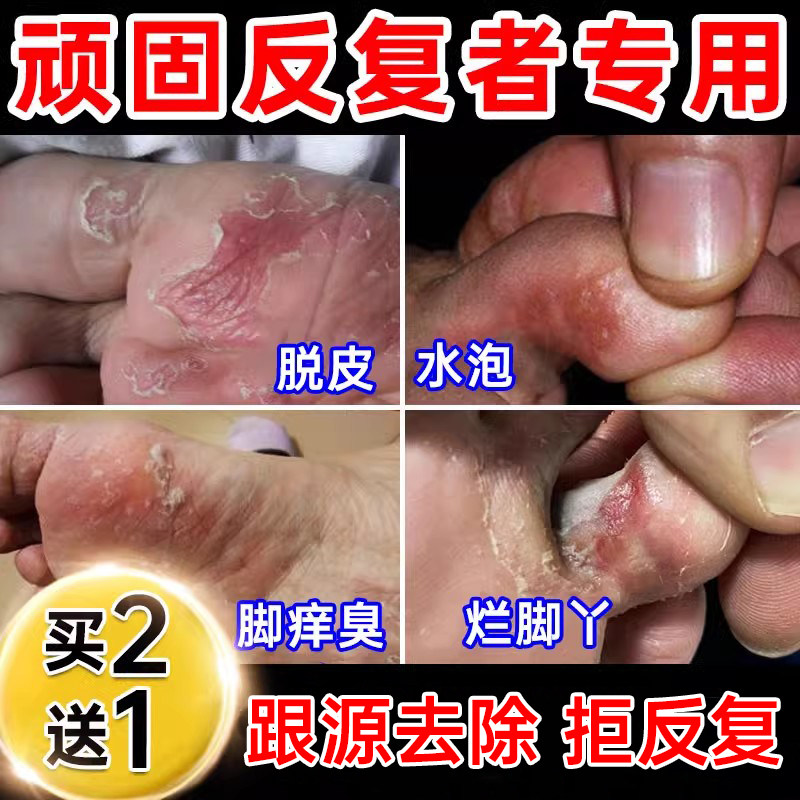 去脚气膏药止痒脱皮杀菌真菌感染烂脚丫药脱皮糜烂脚趾痒【临期】