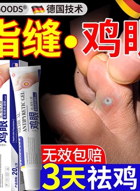 鸡眼膏脚指钉祛除膏鸡茧眼足部去脚趾头缝硬老茧肉刺根专用正品zz