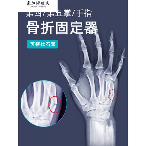 掌骨骨折固定器手掌骨折支具夹板第四第五掌骨手指骨折固定护具