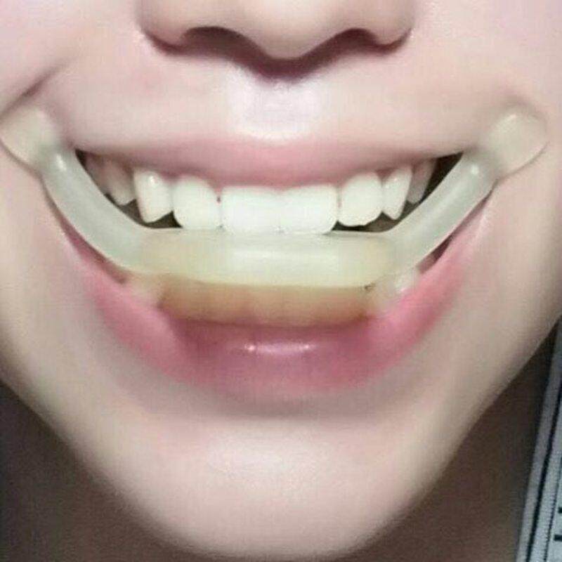 微笑唇训练器矫正保持器