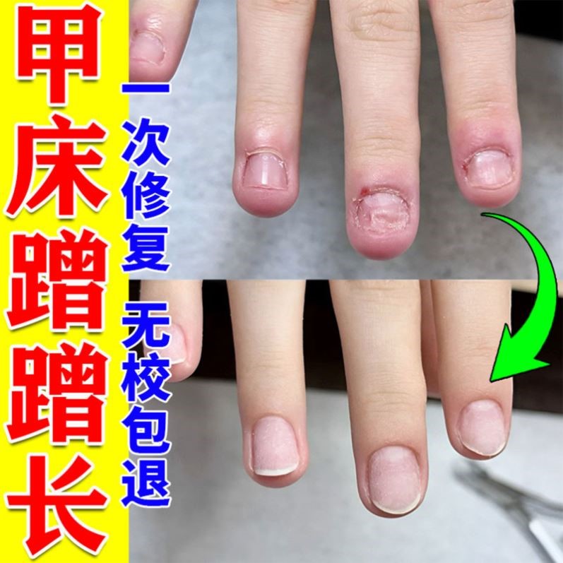 指甲修复液受损再生养甲床儿童空啃咬增厚凹凸不平蛋白快速增长油