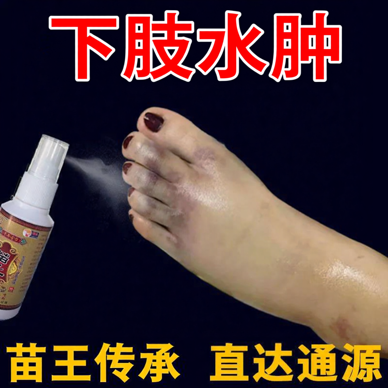 苗王 去水肿消肿专用的药老人脚肿消水肿止疼痛活络血化瘀喷雾剂