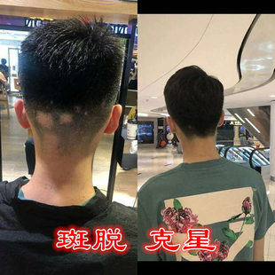 生发丸九芝堂养发白发药物男士增发密发秃头斑秃防脱发药治疗