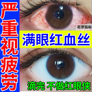 色苷酸钠眼药水五景色甘滴眼液色干色酸甘钠过敏性结膜炎