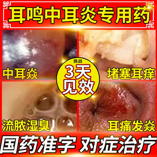 头孢呋辛酯颗粒中耳炎专用药急性细菌性耳痛耳道流水或流脓