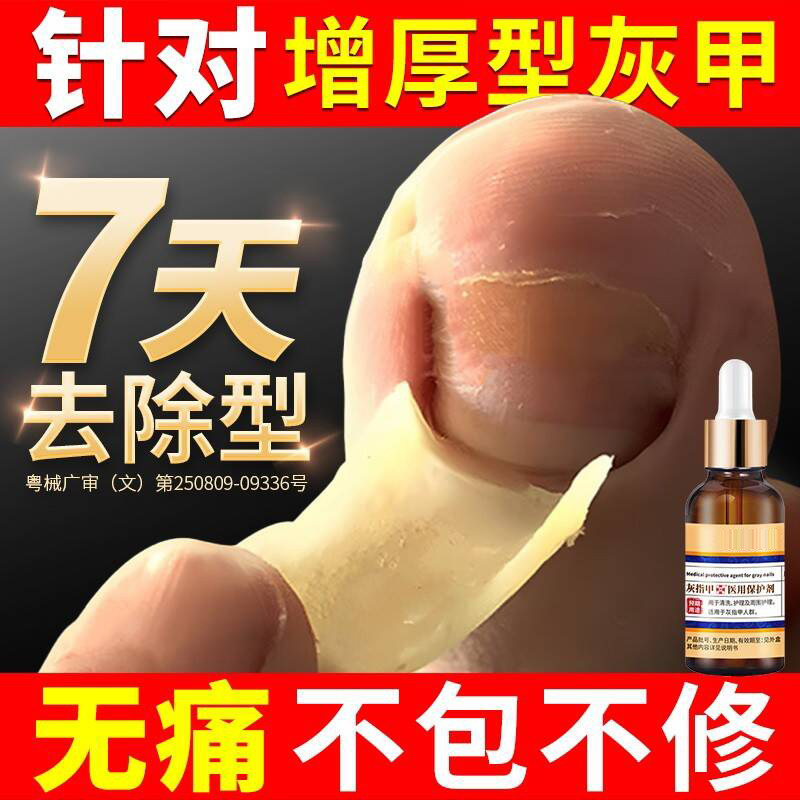 灰指甲脱甲膏去除增厚抑菌液脚趾官方旗舰店正品用冰醋酸30