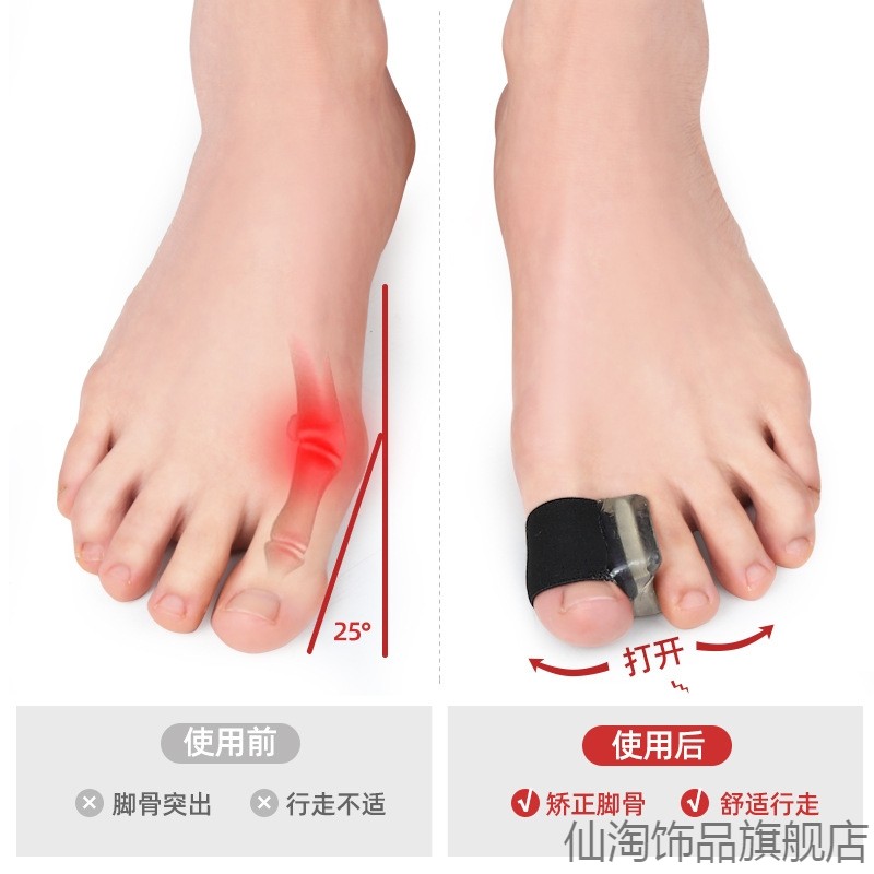 骨器女士分指日夜修正分离器硅胶关节指头舒适脚趾拇指外翻矫正器