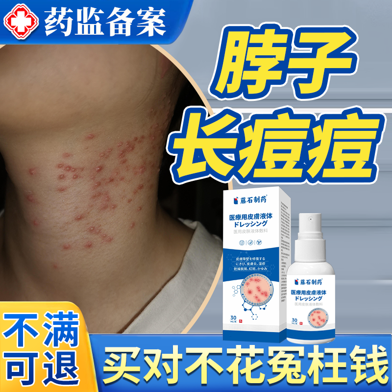 脖子上长痘痘毛囊炎后面硬疙瘩鸡皮肤脂溢性皮炎马色拉菌喷雾剂JW