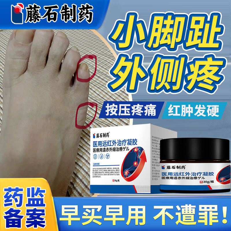 小脚趾头外侧疼痛滑囊炎消肿止疼药监备案膏可搭小脚趾防磨神器EM