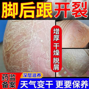 脚后跟开干裂鳞屑角化型脚气泡脚去真菌感染可搭药包软化角质BS