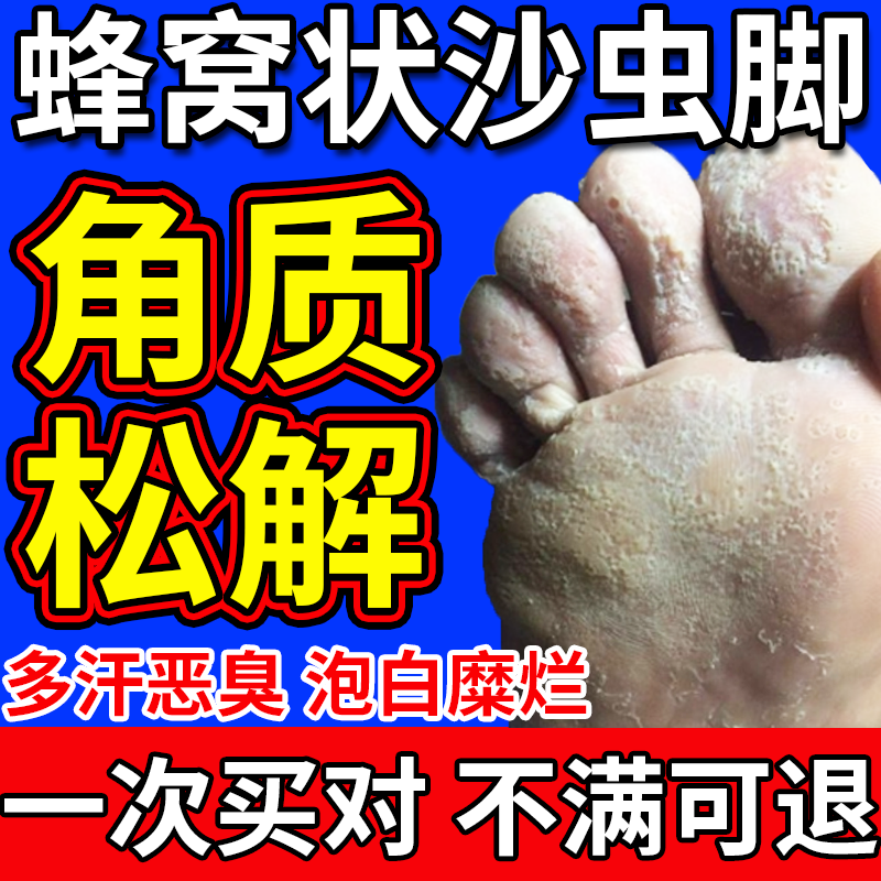 窝状角质松解症脚气脚底真菌感染起泡蜂窝状沙虫脚脚掌发白喷剂em