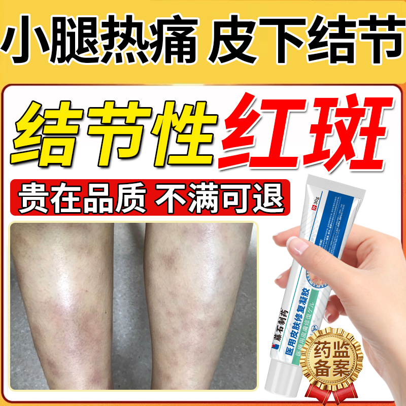小腿下肢结节性红斑皮肤发红皮肤消肿止疼药房同款硬疙瘩痒疹BS,保健用品,皮肤消毒护理（消）,淘宝优惠券,粉丝福利购,淘宝优惠卷