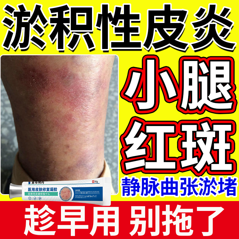 淤积性皮炎专用静脉炎药房同款膏静脉曲张湿疹止痒皮肤小腿OZ