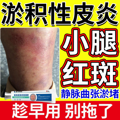 小腿红斑】淤积性皮炎趁早用别拖