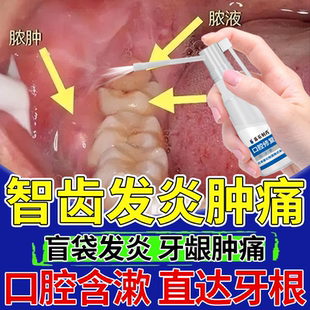 智齿发炎漱口水牙龈肿痛消炎止疼冠周炎药房房同售生理盐水漱口OZ