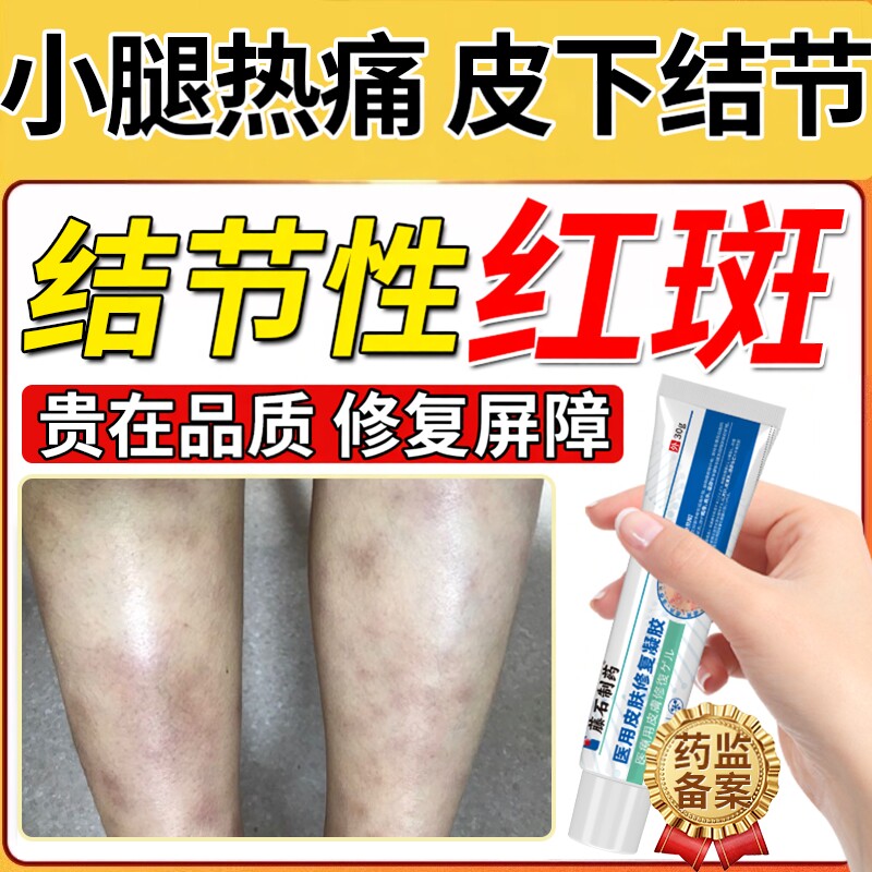 小腿下肢结节性红斑皮肤发红皮肤消肿止疼药房同款硬疙瘩痒疹BS
