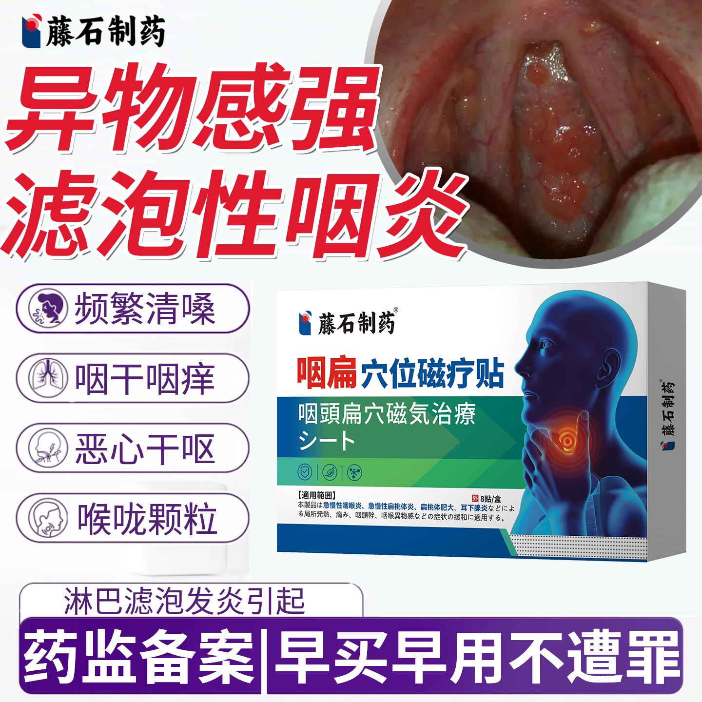滤泡性咽炎滤泡增生慢性咽喉炎专特用效膏药贴喉咙痒干咳异物感EM