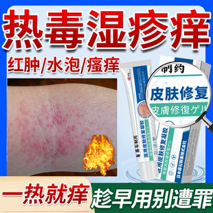 热毒湿疹止痒膏皮肤一热就痒搭清热解毒血热性去除湿根热疹成人OZ