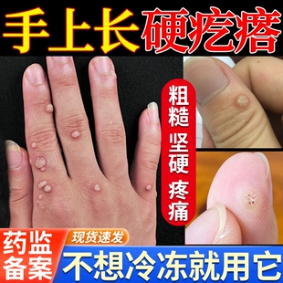 手上长硬疙瘩寻常疣膏去除甲周疣根刺猴瘊子神器祛疣除疣专用贴JW