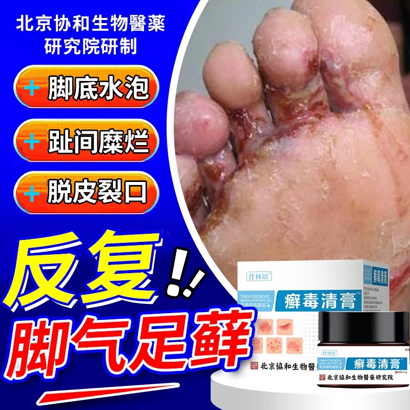 足癣脚癣一次净特效去脚气根止痒专用泡脚足光粉薬膏真菌感染bs