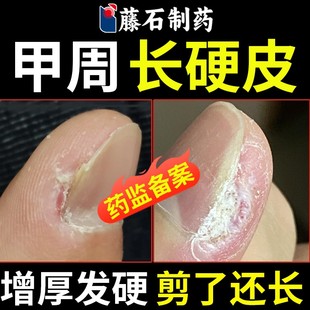 软化手指头硬皮指甲边缘去死皮老硬茧角质茧子甲周软化剂神器膏OZ