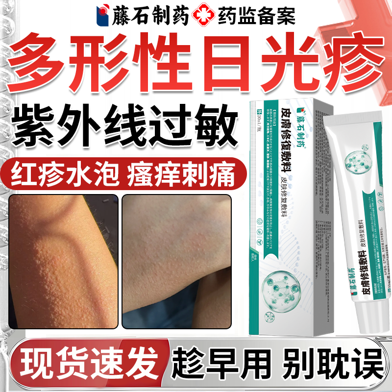 日光性皮炎日光疹紫外线过敏太阳晒伤专用止痒修复霜药房同款膏BS