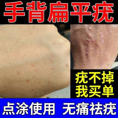 【医用级】手背扁平疣就用它