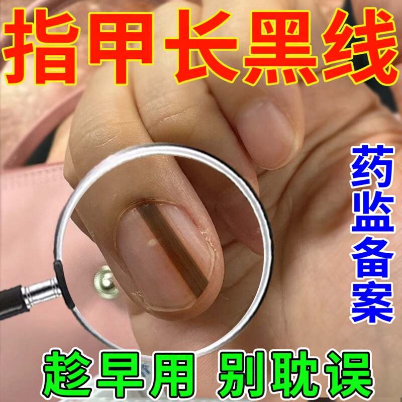 甲母痣黑指甲专用膏指甲淤血长黑线去黑指甲黑条正品薬房同款膏JW