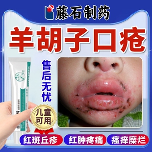 湿毒康软膏羊胡子疮口周炎专用儿童山羊胡唇炎唇周疮药房同款膏EM