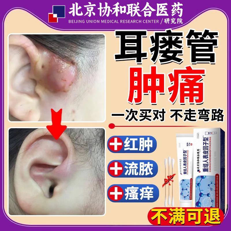 耳瘘耳前瘘管清理中防水贴药房同款膏耳仓发炎红肿疼痛瘙痒流脓bs