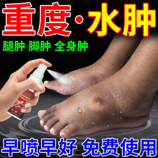 消去肿水肿专用药治老人脚肿利尿排水肿湿气大小腿下肢浮肿特效贴