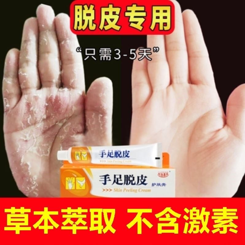 专治手脱皮的药膏儿童成人手指真菌感染手脚干裂蜕皮干燥起皮软膏