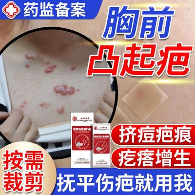 胸口疤痕疙瘩痘前去增生凸