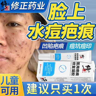 水痘疤痕水痘坑祛疤痘印去黑色素沉淀凹陷性疤痕增生凸起愈合KV