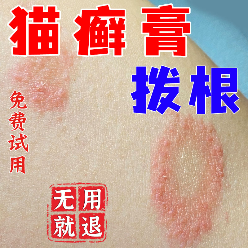 人患猫藓猫癣专用药人用外用药膏人得防传染身上长癣玫瑰糠疹止痒