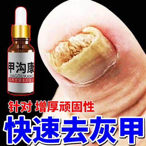 新品甲沟康趾甲沟脚指甲长肉里面非剪专用K到往勾甲炎药入肉修复