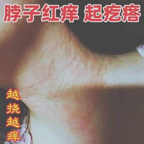 极速脖子红痒f刺挠起癣长疙瘩疹子红肿晒伤过敏性皮炎全身皮肤痒