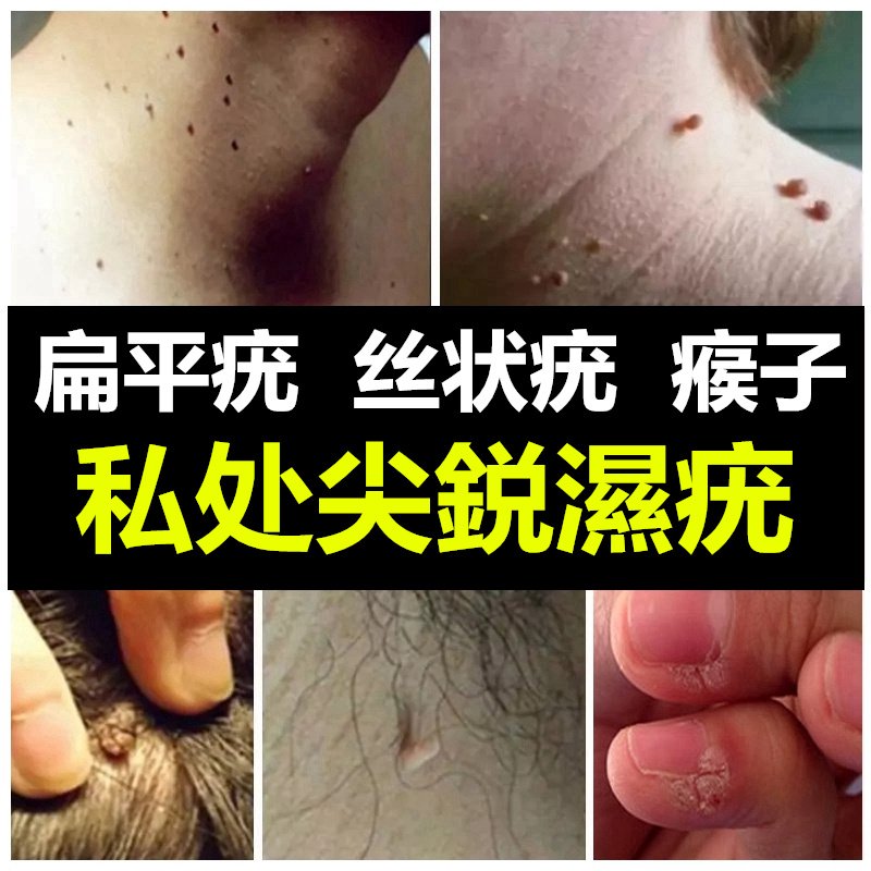 疣必治去扁平疣面部一抹灵克星去除膏颈部手部治丝状