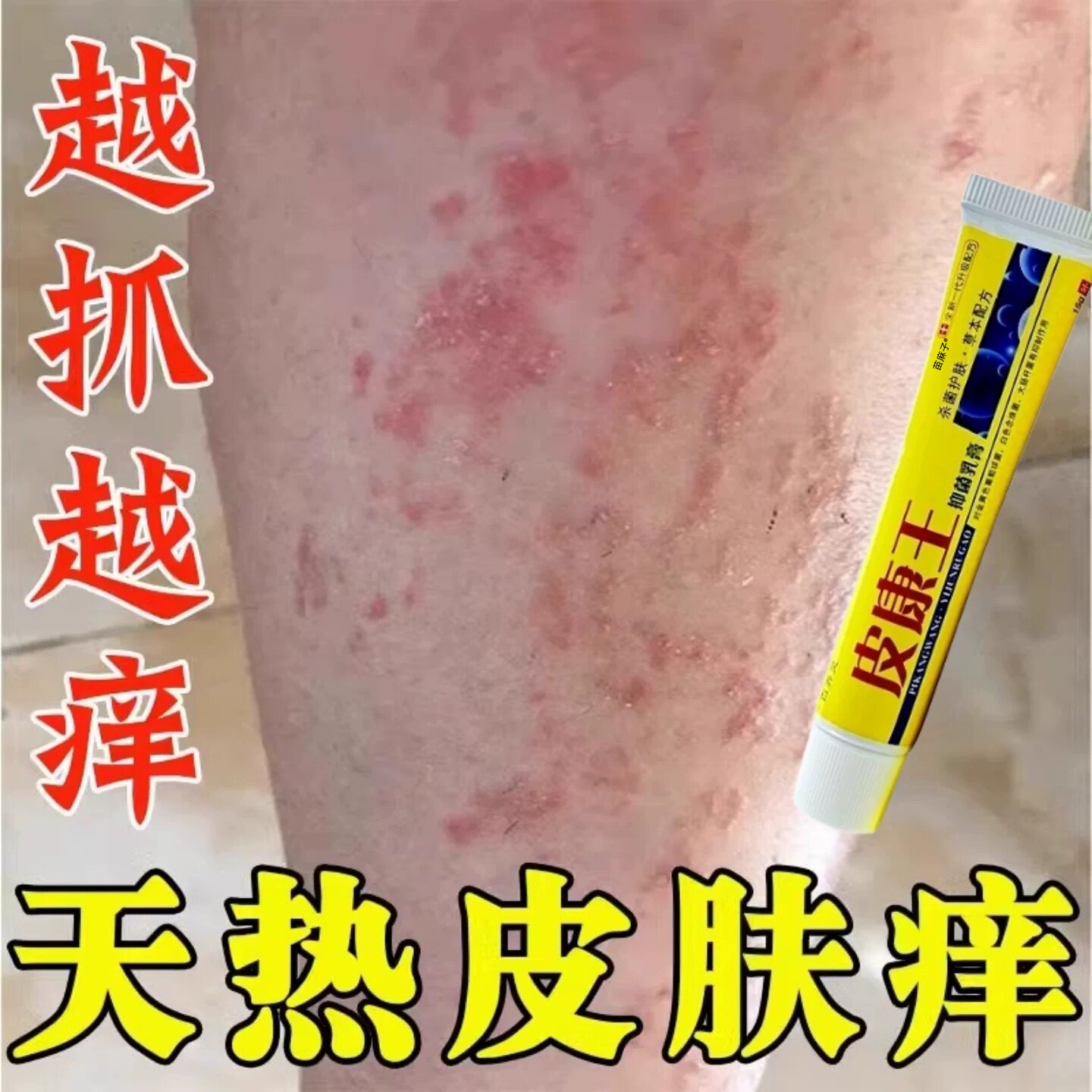 夏天小腿痒湿成人止痒膏出汗身上痒天热皮肤痒瘙热疙瘩红疹热毒