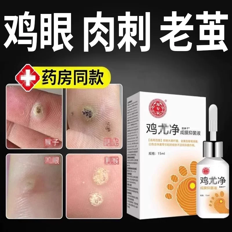 鸡眼膏贴去尤瘊小肉粒神器清疣膏肉刺去除药膏跖疣专膏用去疣瘊根