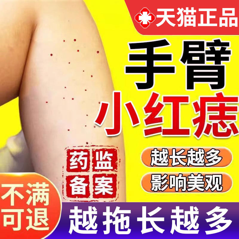 樱桃状血管瘤血管痣药监备案膏点红痣凝胶痣点痣无痕正品去蜘蛛痣