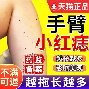 樱桃状血管瘤血管痣药监备案膏点红痣凝胶痣点痣无痕正品去蜘蛛痣