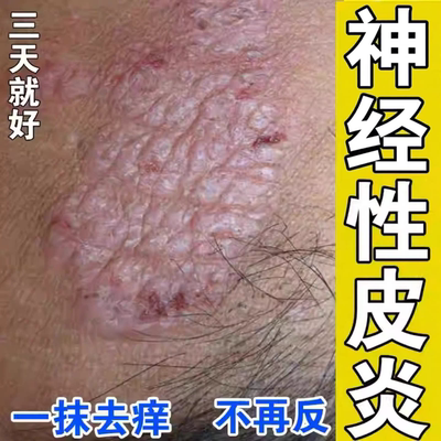 苗癣王抑菌膏【选对正品】！