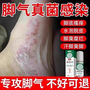 去脚气喷雾特止痒根脱皮杀菌水泡烂脚丫香港脚糜烂专脚趾缝痒用效