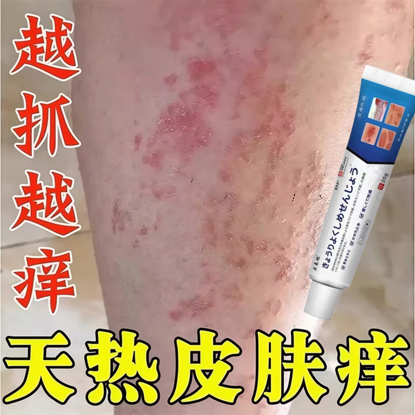 日本止痒王抑菌软膏夏天小腿痒出汗湿痒皮肤瘙痒疹热疙瘩红疹热毒